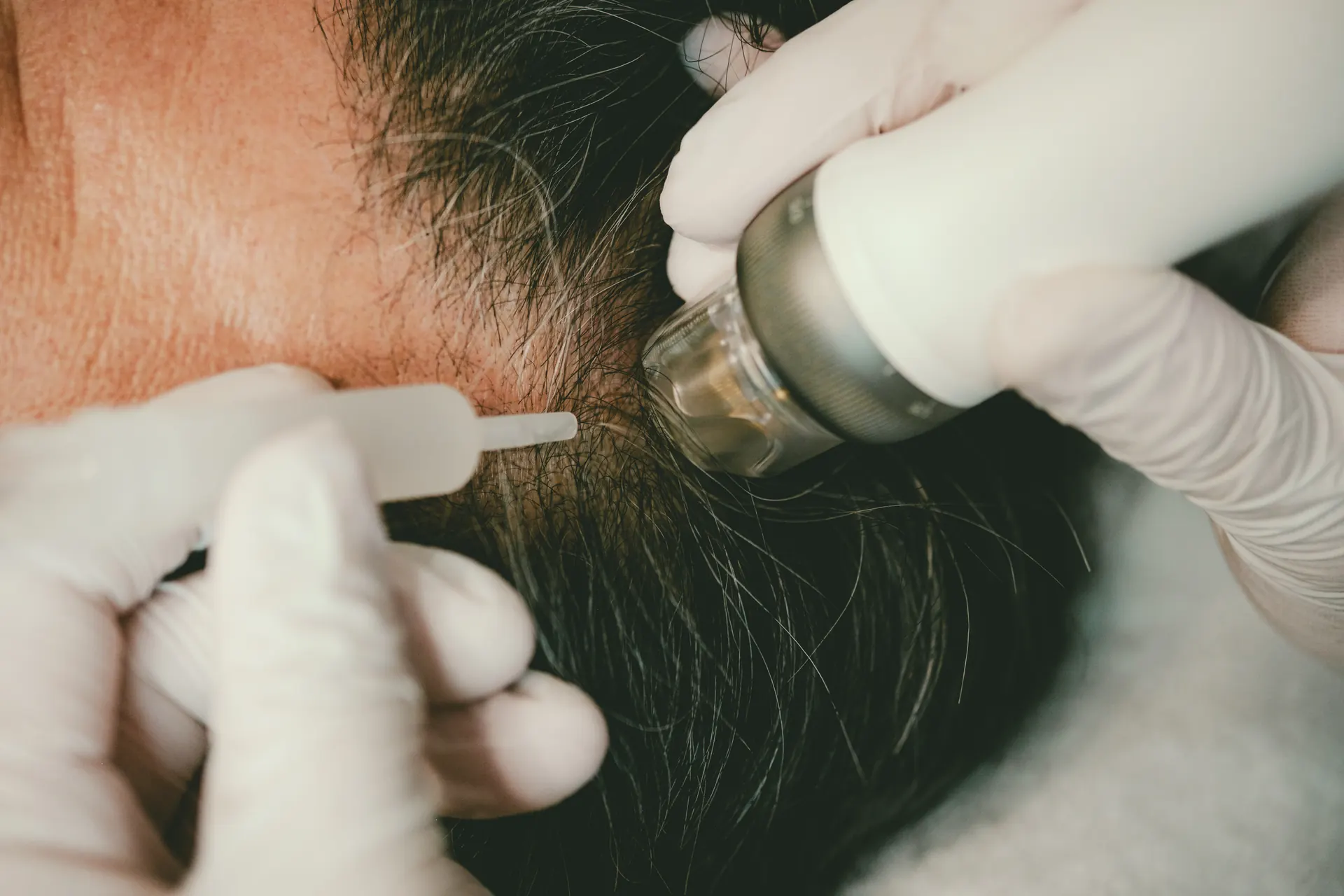 導入施術の施術風景