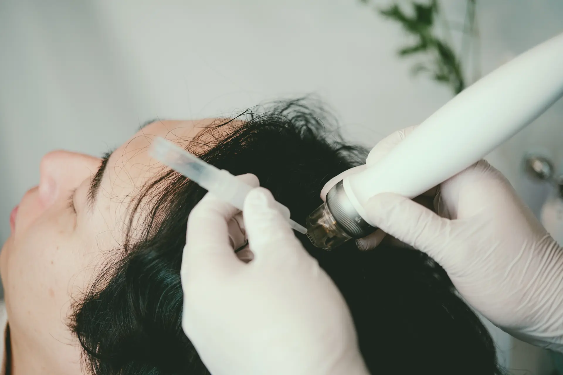 ヒト幹細胞培養上清液と非加熱プラセンタによる頭皮改善スカルプケア施術