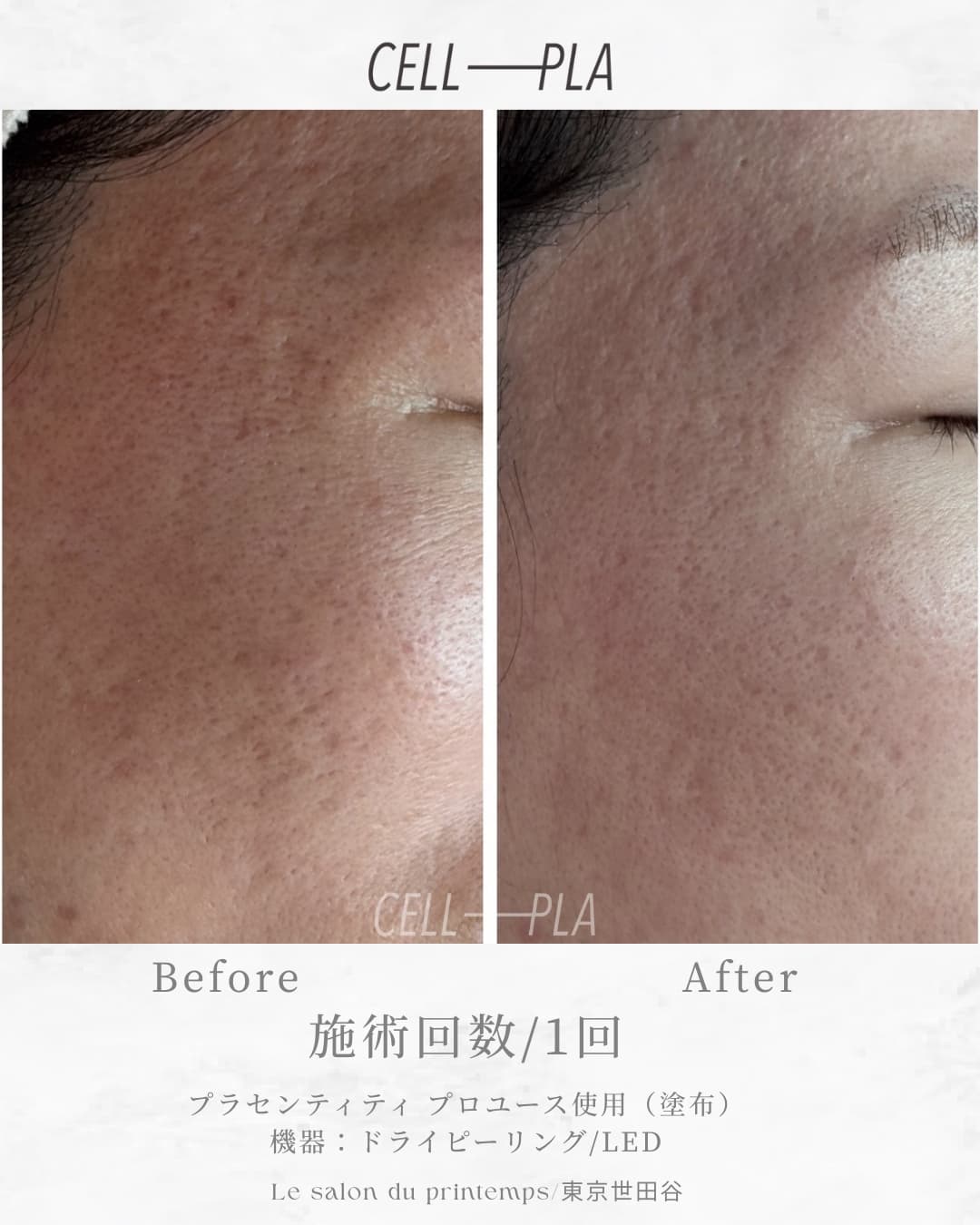 施術1回 Before & After