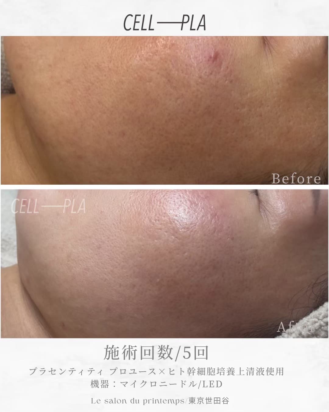 施術5回 Before & After